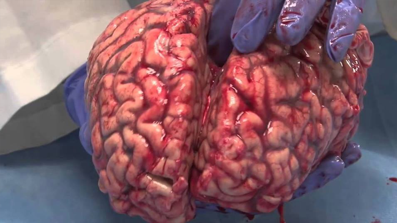 Cirurgião promete transplantes de cérebro até 2020